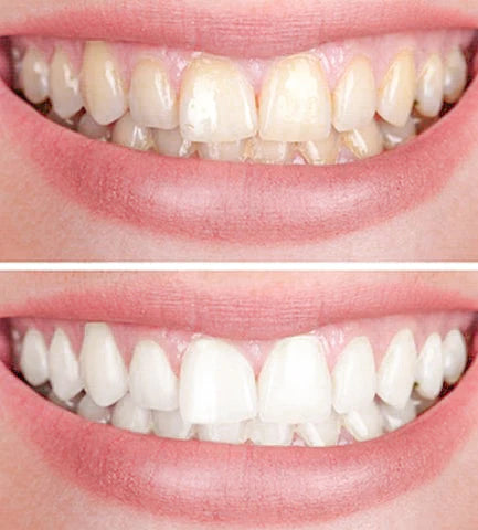 GlowWhiten | Teeth Whitener